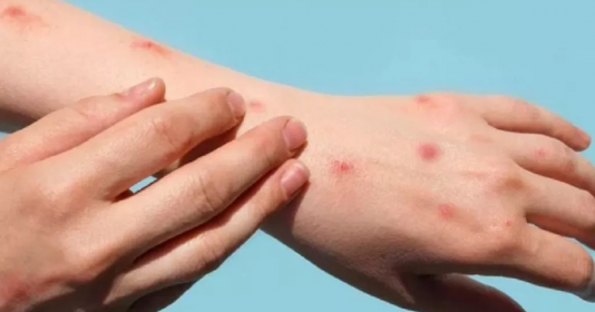 Bệnh đậu mùa khỉ có thể lây lan trước khi xuất hiện triệu chứng