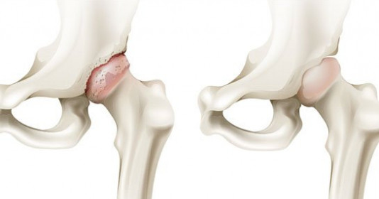 Lạm dụng rượu và thuốc lá, giới trẻ bị hoại tử chỏm xương
