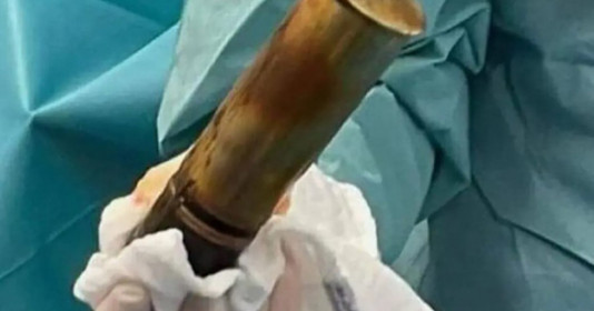 Bệnh nhân cấp cứu với một quả đạn pháo kẹt trong hậu môn