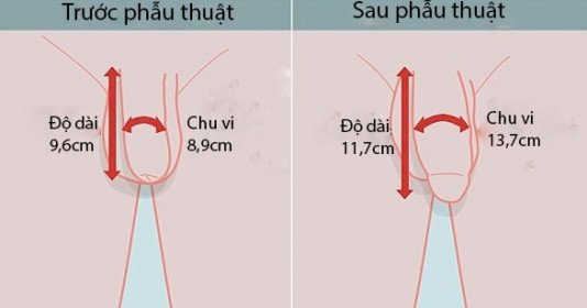 Có làm tăng kích thước dương vật được không?