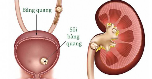 Nhận biết triệu chứng của sỏi bàng quang và cách điều trị