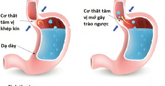 Người bị trào ngược dạ dày làm tăng nguy cơ mắc ung thư thực quản