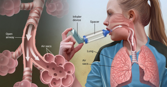 Pháp phát triển vaccine phòng bệnh hen suyễn