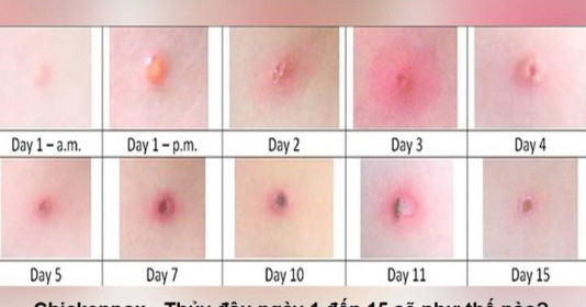 Số ca khám và nhập viện vì mắc thủy đậu tại bệnh viện gia tăng