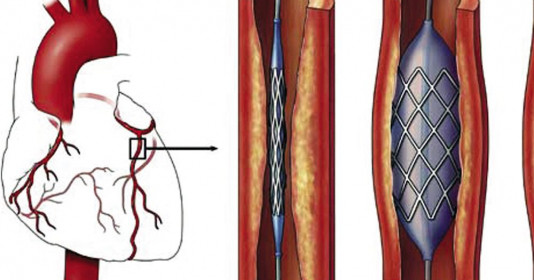 Bệnh nhân đặt stent tim có được hưởng BHYT?