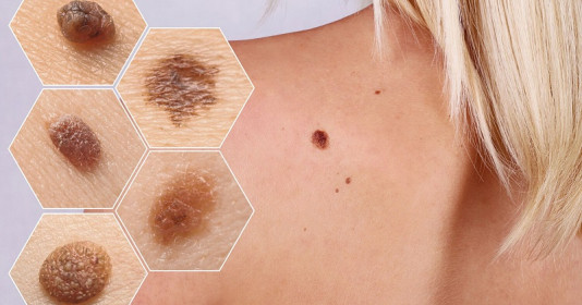 Đột phá lớn trong nghiên cứu về phương pháp điều trị ung thư da