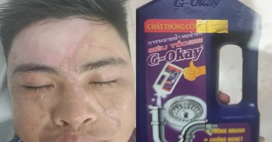 Bỏng phải cấp cứu do dùng nước thông cống siêu tốc