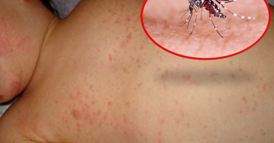 Gia Lai: Sốt xuất huyết bùng phát mạnh