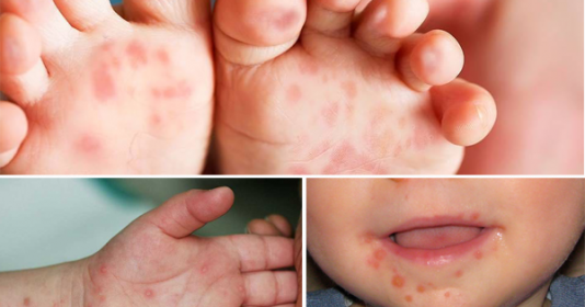 Đắk Lắk: Bé trai 1 tuổi tử vong vì bệnh tay chân miệng