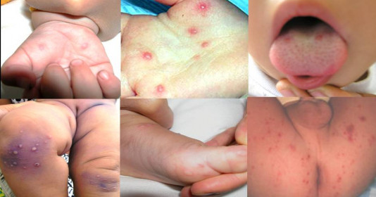 Ca mắc tay chân miệng gia tăng, Bộ Y tế yêu cầu cơ sở y tế sẵn sàng tiếp nhận ca nặng