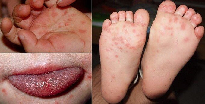 Bộ Y tế khuyến cáo trẻ mắc tay chân miệng phải cách ly 10 ngày