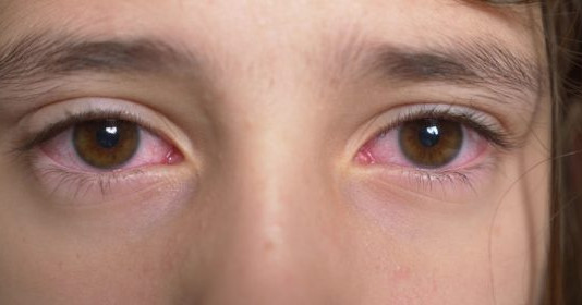 Bệnh đau mắt đỏ đang gia tăng, cần làm gì để phòng bệnh?