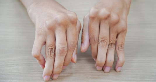 “Đột phá” trong chữa trị bệnh viêm đa khớp dạng thấp
