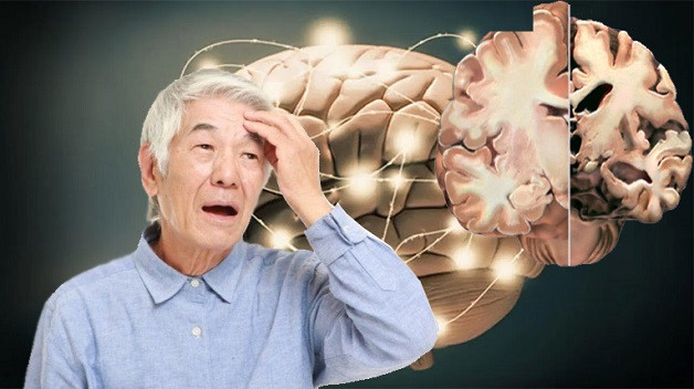 Nguyên nhân, triệu chứng và các biện pháp phòng ngừa bệnh Alzheimer