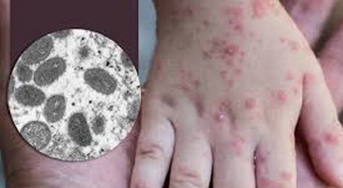 Đồng Nai phát hiện trường hợp đầu tiên mắc đậu mùa khỉ