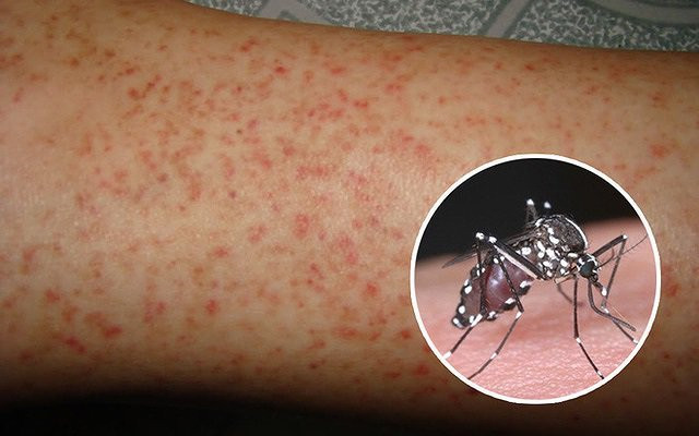 UBND TP Cần Thơ: Tăng cường công tác phòng, chống bệnh sốt xuất huyết