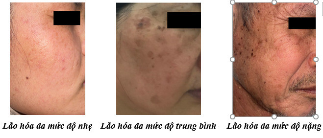 Biểu hiện, nguyên nhân, các phương pháp làm chậm và cải thiện tình trạng lão hóa da