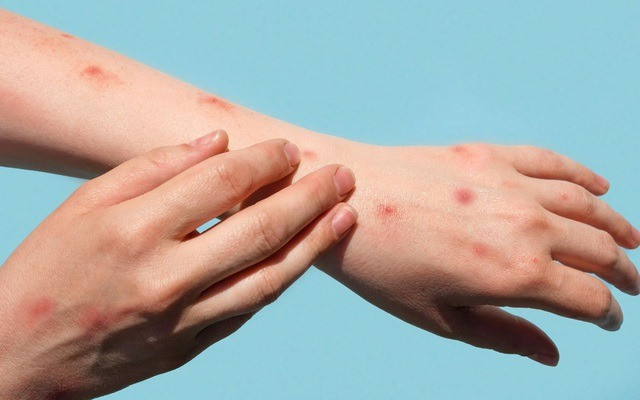 TP. HCM ghi nhận thêm 4 trường hợp mắc đậu mùa khỉ