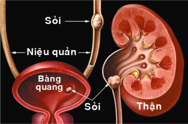 Cách phòng ngừa sỏi tiết niệu