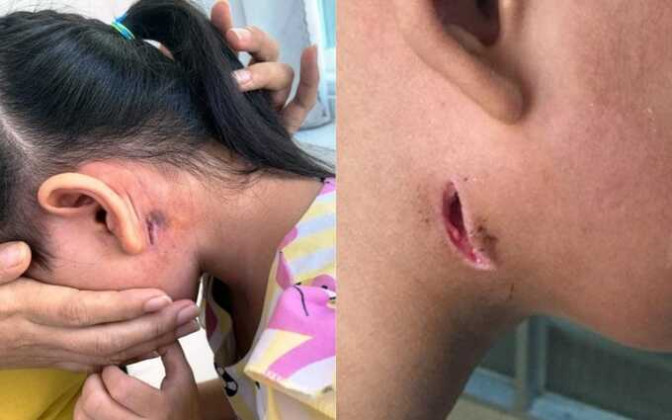 Cảnh giác với vi khuẩn ‘ăn thịt người’ gây bệnh Whitmore