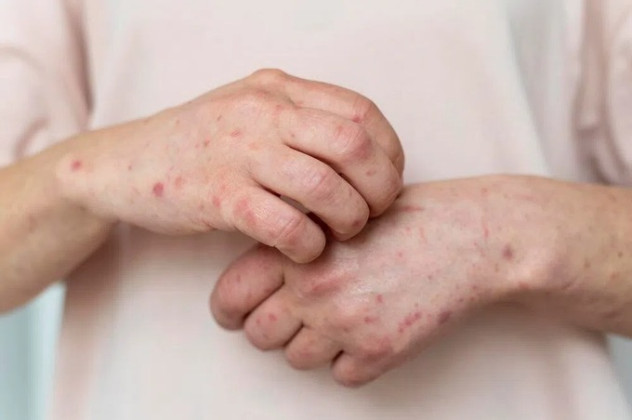 TP. HCM: Ca tử vong đầu tiên liên quan đến bệnh đậu mùa khỉ
