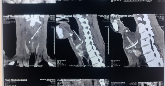 Bệnh viện Tai Mũi Họng TP. HCM: Phẫu thuật thành công cho bệnh nhân hóc xương cá dài 35mm