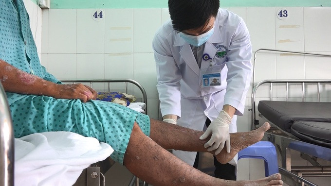 Viêm khớp vảy nến: Điều trị sớm để tránh nguy cơ tàn phế