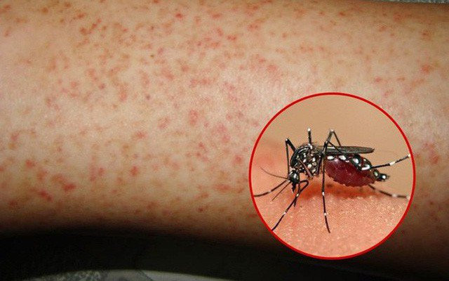 Phân biệt sốt xuất huyết và sốt thông thường