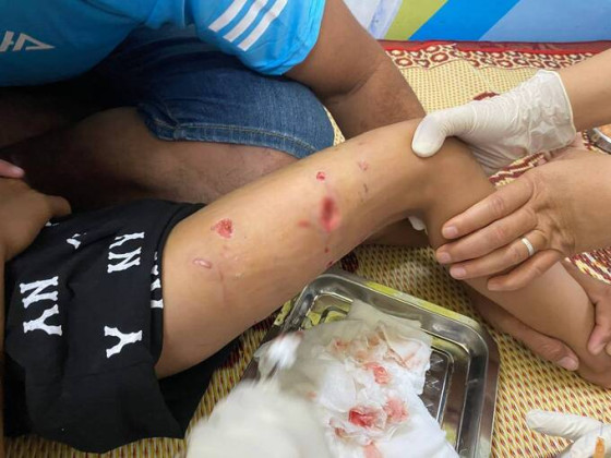 Thừa Thiên Huế: Tiếp nhận tiêm chủng bệnh nhi bị chó cắn với nhiều vết thương sâu