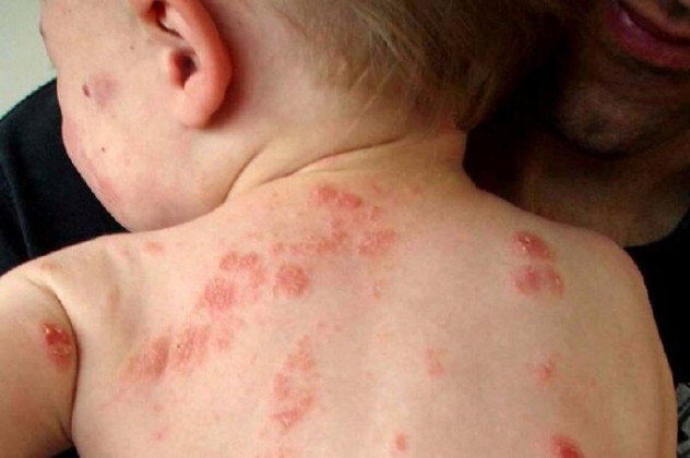 Bệnh chốc, bệnh lý da thường gặp ở trẻ em