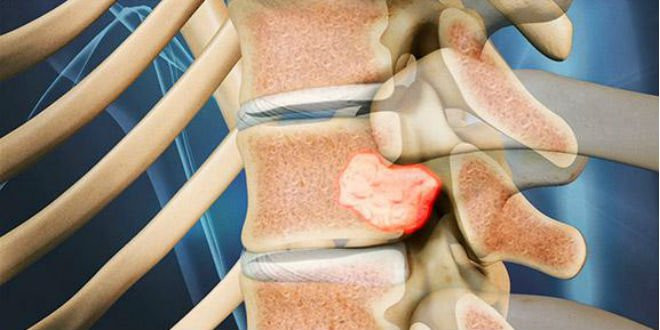 Điều trị sớm u tủy sống phòng, chống nguy cơ bị liệt