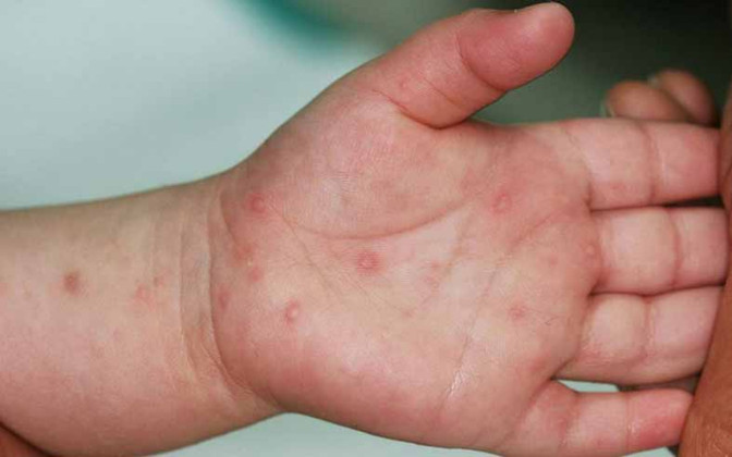 Cà Mau: Cảnh giác với bệnh tay chân miệng nặng
