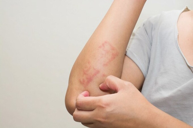 Phòng bệnh viêm da tiếp xúc