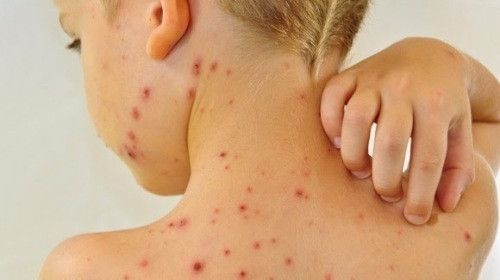 Cảnh giác bệnh thủy đậu hoại thư
