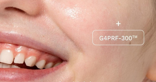 G4PRF-300™ thế hệ nâng cấp exosome