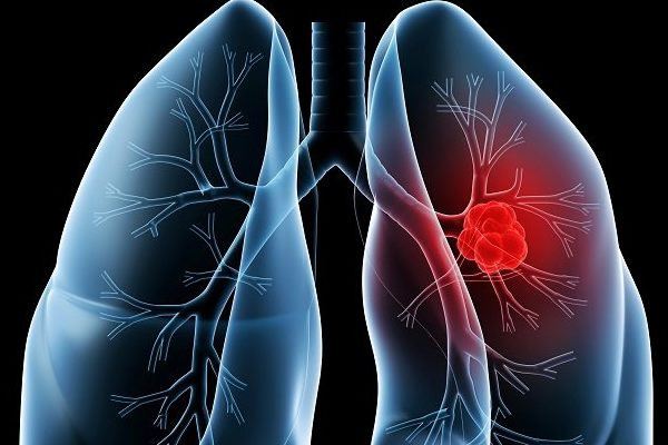 Những lưu ý khi mắc bệnh phổi tắc nghẽn mãn tính