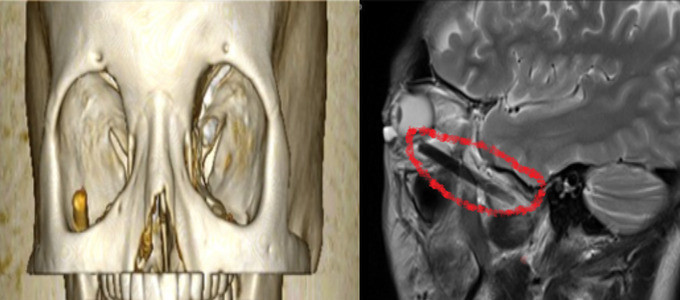 Bình Dương: Phẫu thuật lấy dị vật dài 6cm trong hốc mắt