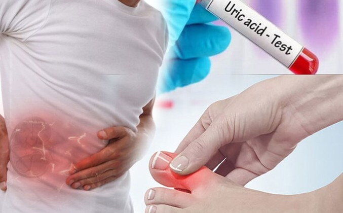 Cách giúp thận không bị tổn thương khi axit uric tăng cao