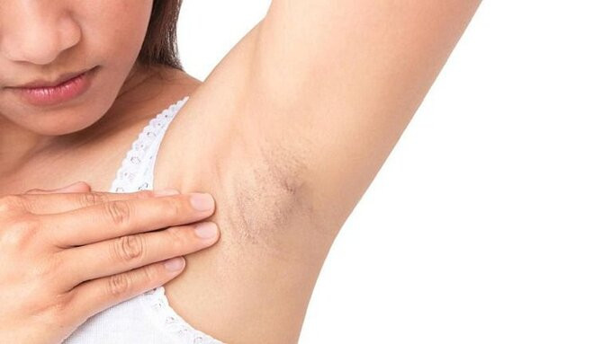 Nguyên nhân, cách ngăn ngừa và điều trị dị ứng nách