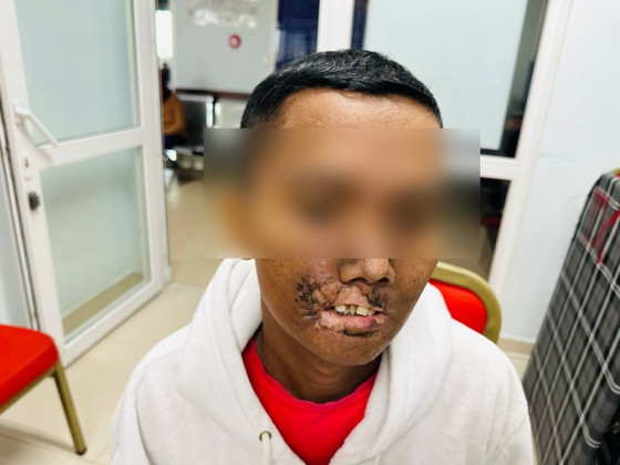 Bệnh viện Ung bướu Đà Nẵng điều trị thành công khối u khổng lồ vùng môi bằng hóa xạ trị