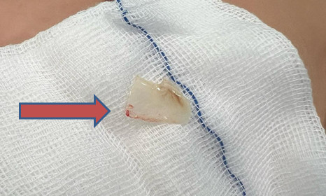 TP. HCM: Cấp cứu bệnh nhi 2 tuổi bị hóc xương cá