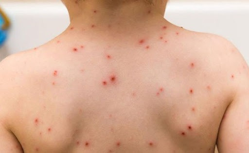 Đắk Nông ghi nhận 5 ổ dịch thủy đậu với 34 ca mắc