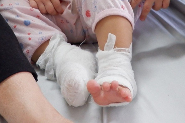 Bé gái 4 tuổi bị bỏng nặng do cồn