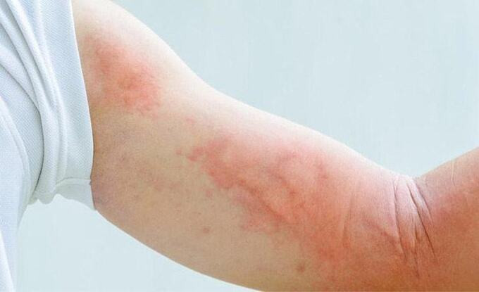 Nhận biết và phòng, chống bệnh toxocara