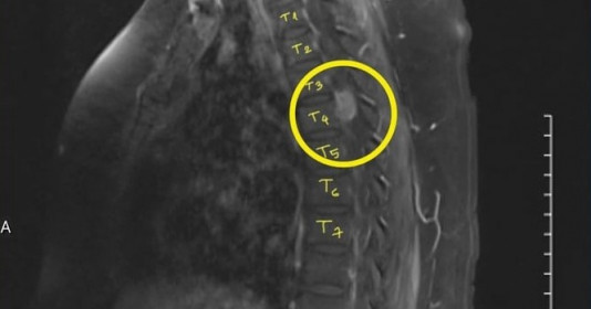 Bình Dương: Phẫu thuật thành công ca u màng tủy T3-T4, giúp bệnh nhân thoát khỏi cảnh liệt 2 chân