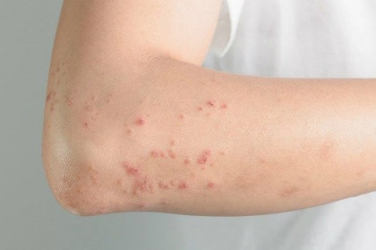Ghi nhận 42 ca mắc bệnh sởi tại 13 tỉnh, thành phố