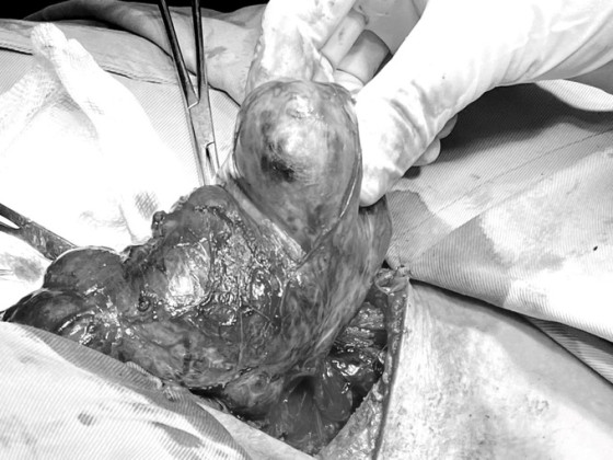 Đà Nẵng: Cắt bướu giáp khổng lồ thòng trung thất cho nữ bệnh nhân 50 tuổi
