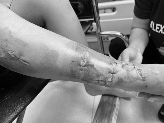 Cấp cứu kịp thời bé trai 10 tuổi bị kiếng cắt vào cổ chân