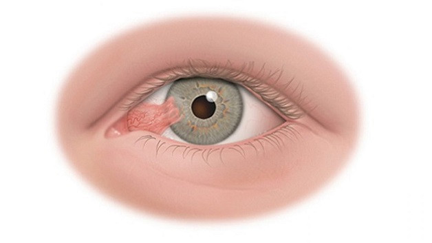 Cẩn trọng với bệnh viêm loét giác mạc do nấm