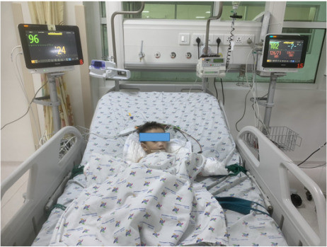 Cứu sống bệnh nhi 14 tháng tuổi bị viêm ruột gây tắc ruột thủng ruột